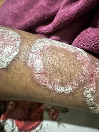 Psoriasis in my lower limb